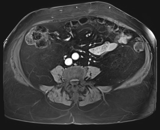 File:Adrenal cortical carcinoma (Radiopaedia 64017-72770 J 68).jpg