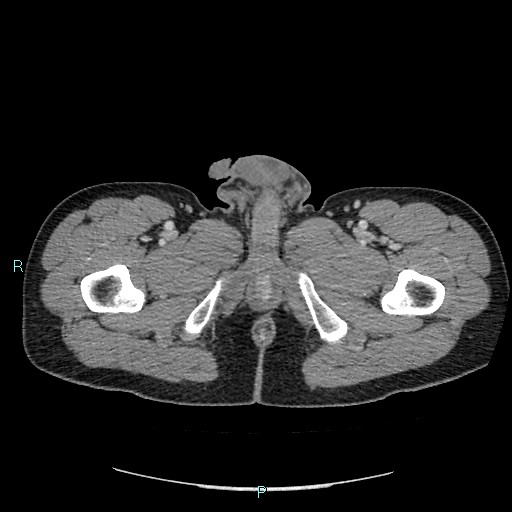Adrenal cystic lymphangioma (Radiopaedia 83161-97534 Axial C+ portal venous phase 111).jpg