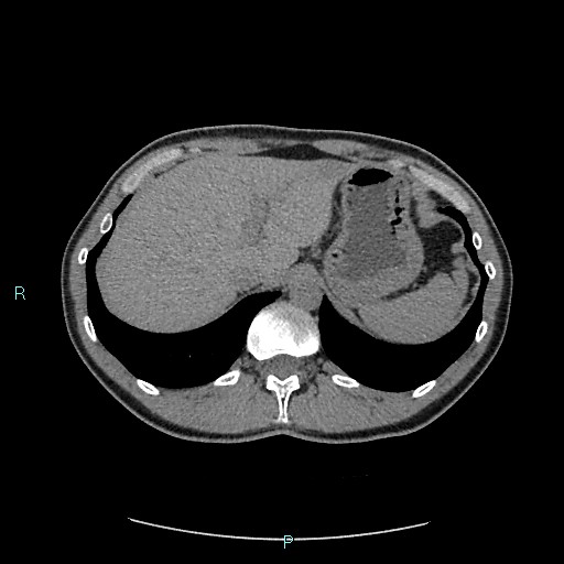 Adrenal cystic lymphangioma (Radiopaedia 83161-97534 Axial non-contrast 22).jpg