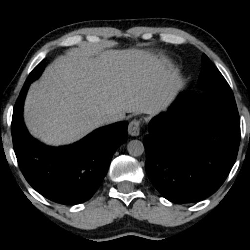 File:Adrenal gland trauma (Radiopaedia 81351-95079 Axial non-contrast 12).jpg