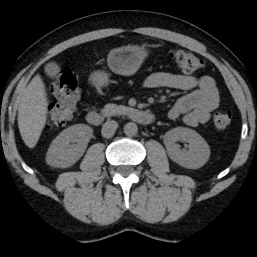 Adrenal gland trauma (Radiopaedia 81351-95079 Axial non-contrast 51).jpg