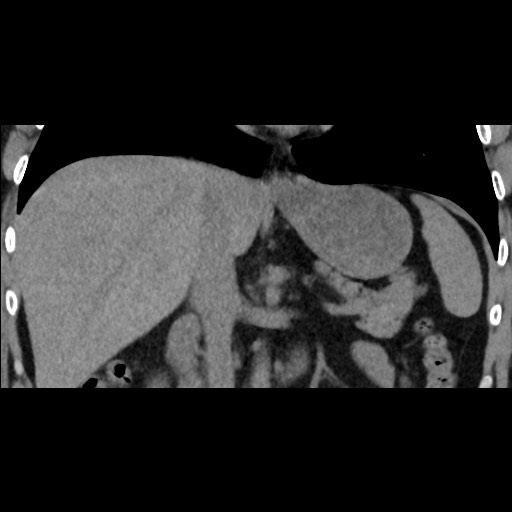 Adrenal gland trauma (Radiopaedia 81351-95079 Coronal non-contrast 47).jpg