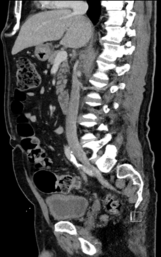 Adrenal lymphoma (Radiopaedia 73730-84529 Sagittal C+ portal venous phase 52).jpg