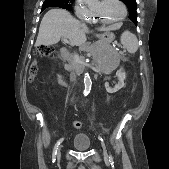 Adrenal lymphoma (Radiopaedia 84145-99415 Coronal C+ portal venous phase 40).jpg