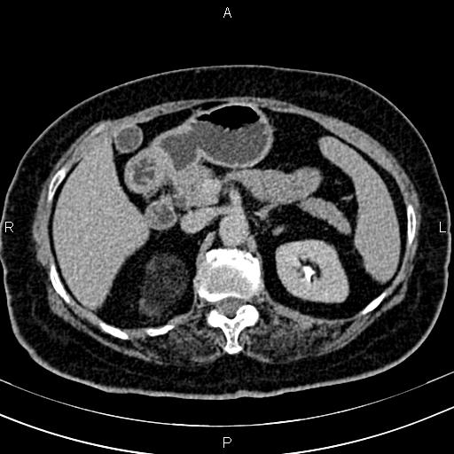 Adrenal myelolipoma (Radiopaedia 82742-96986 Axial renal excretory phase 47).jpg