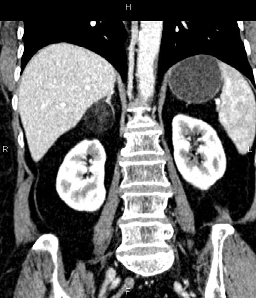 Adrenal myelolipoma (Radiopaedia 82742-96986 Coronal renal cortical phase 50).jpg