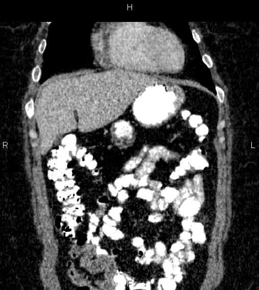 Adrenal myelolipoma (Radiopaedia 84319-99617 Coronal renal cortical phase 17).jpg