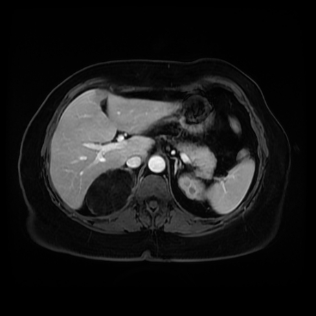 Adrenal myelolipoma - MRI (Radiopaedia 83249-97646 T1 fat sat arterial phase 26).jpg