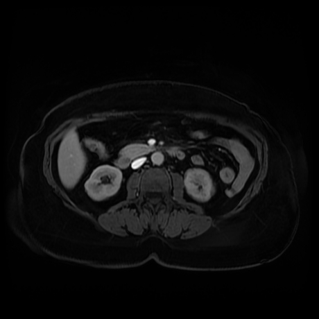 Adrenal myelolipoma - MRI (Radiopaedia 83249-97646 T1 fat sat arterial phase 53).jpg