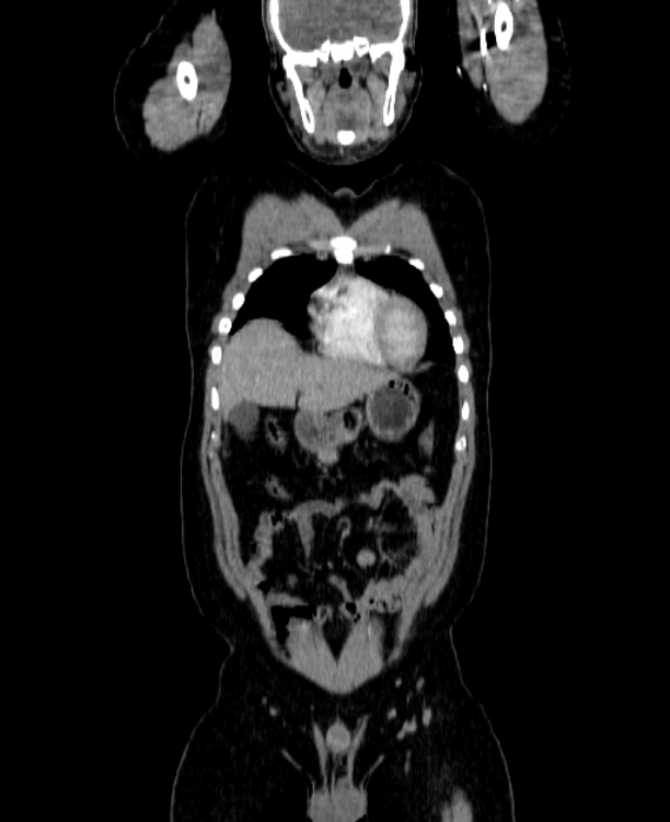 Adrenocortical carcinoma (Radiopaedia 80134-93438 Coronal C+ portal venous phase 44).jpg