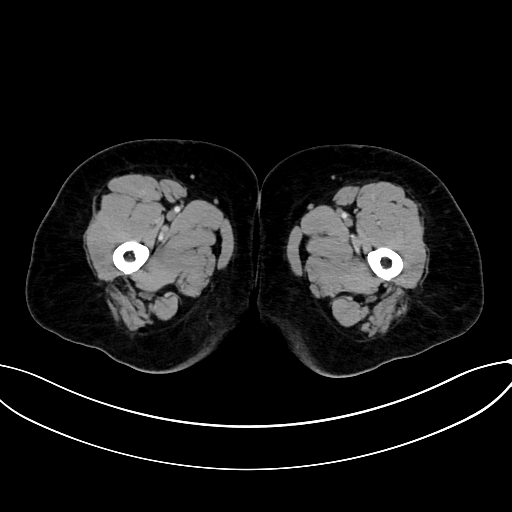 Adrenocortical carcinoma (Radiopaedia 87281-103569 Axial C+ portal venous phase 102).jpg