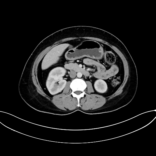 Adrenocortical carcinoma (Radiopaedia 87281-103569 Axial C+ portal venous phase 41).jpg