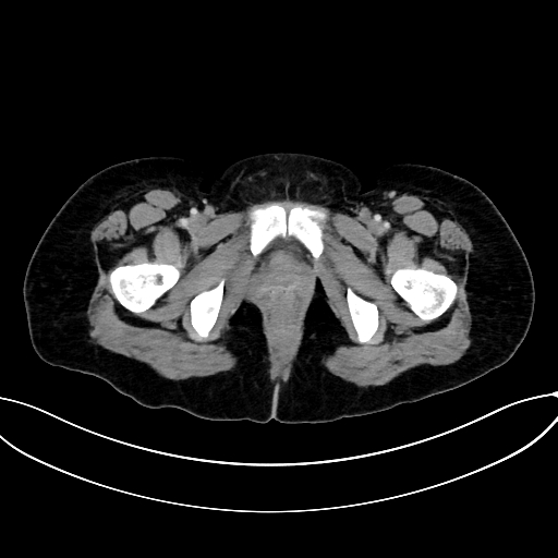 File:Adrenocortical carcinoma (Radiopaedia 87281-103569 Axial C+ portal venous phase 89).jpg