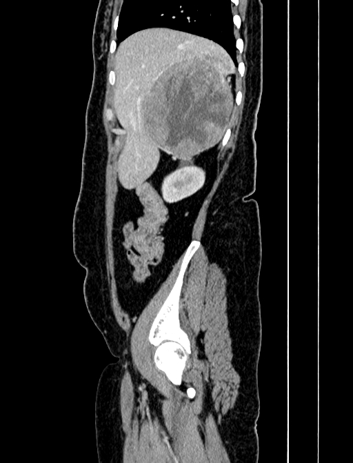 Adrenocortical carcinoma (Radiopaedia 87281-103569 Sagittal C+ portal venous phase 49).jpg