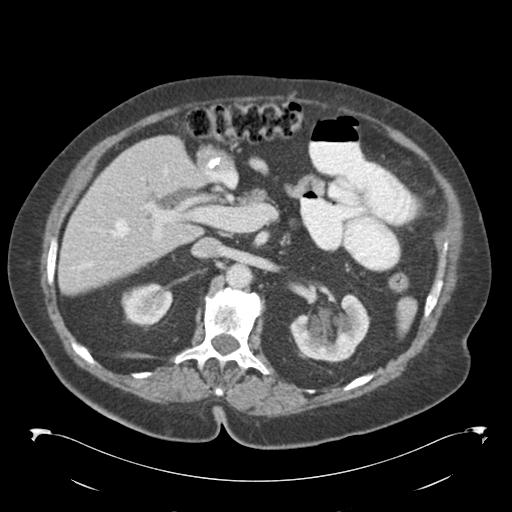 Adult ileal intussusception with secondary obstruction (Radiopaedia 30395-31051 Axial C+ portal venous phase 25).jpg