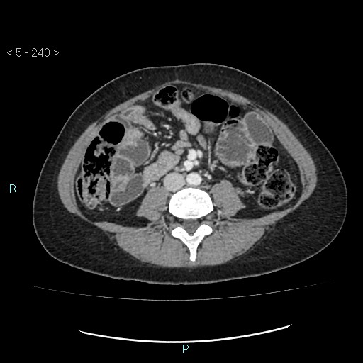 Adult transient intestinal intussusception (Radiopaedia 34853-36310 Axial C+ portal venous phase 49).jpg