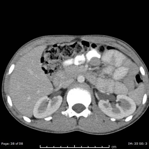 File:Agenesis of the gallbladder (Radiopaedia 55454-61905 B 38).jpg