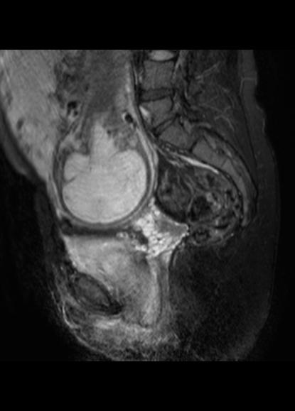 File:Aggressive angiomyxoma of the pelvis and perineum (Radiopaedia 59162-66479 Sagittal T2 fat sat 11).jpg