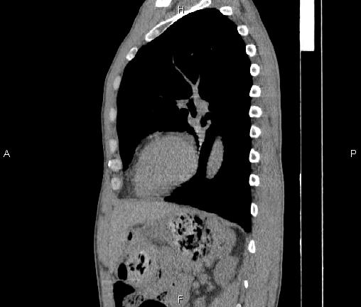 File:Air bronchogram in pneumonia (Radiopaedia 85719-101512 F 64).jpg