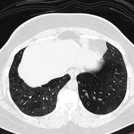 Air trapping in small airway disease (Radiopaedia 61685-69694 Axial lung window 151).jpg