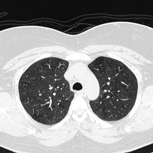 Air trapping in small airway disease (Radiopaedia 61685-69694 Axial lung window 45).jpg