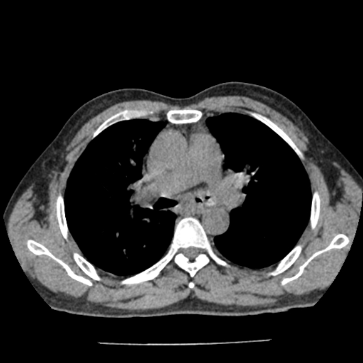 Airway foreign body in adult (Radiopaedia 85907-101779 Axial liver window 65).jpg