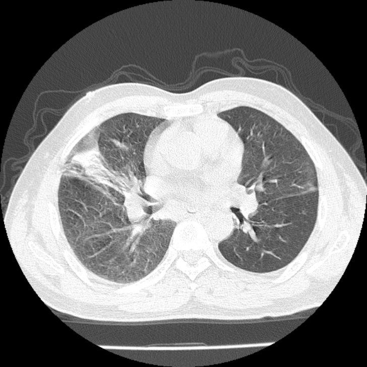 Airway foreign body in adult (Radiopaedia 85907-101779 Axial lung window 89).jpg
