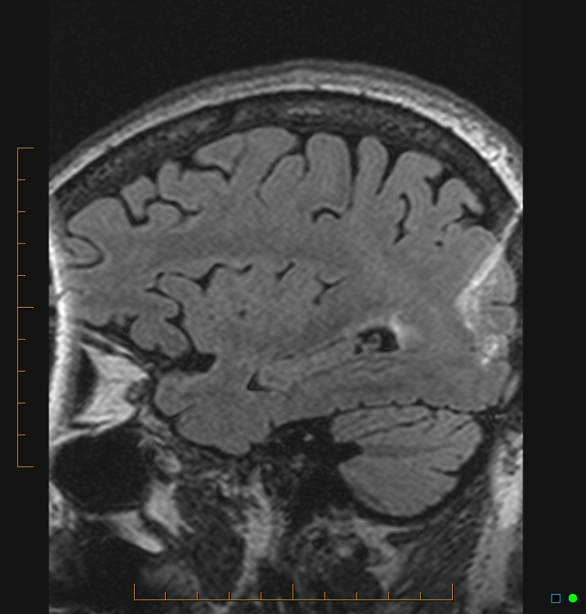 Aliasing artifact causing a spurious cerebellar lesion (Radiopaedia 48783-53810 Sagittal FLAIR 97).jpg