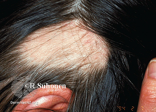 File:Alopecia areata (DermNet NZ hair-nails-sweat-alopecia-areata-1322).jpg