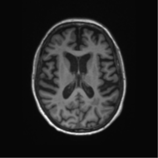 Alzheimer's disease (Radiopaedia 42658-45802 Axial T1 70).png