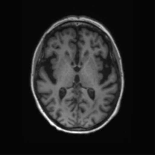 File:Alzheimer's disease (Radiopaedia 42658-45802 Axial T1 80).png