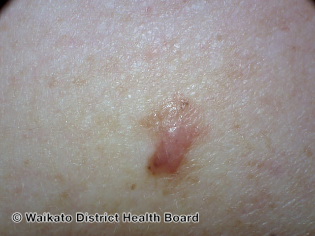 File:Amelanotic melanoma (DermNet NZ amelanotic-melanoma-031).jpg