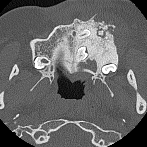 File:Ameloblastic fibro-odontoma (Radiopaedia 18843-18780 C 35).jpg