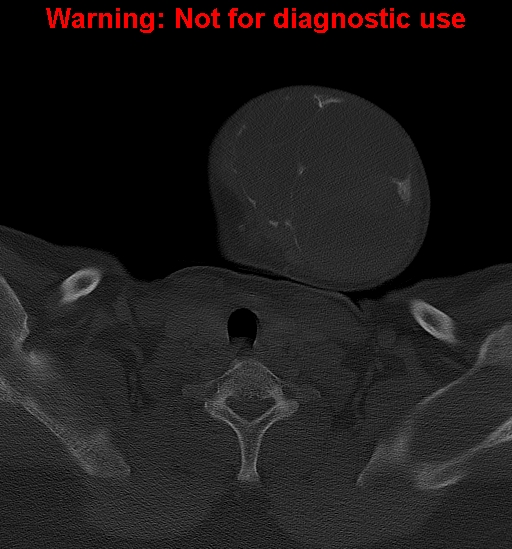 Ameloblastoma (Radiopaedia 33126-34164 Axial bone window 38).jpg