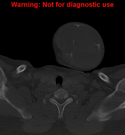 Ameloblastoma (Radiopaedia 33126-34164 Axial bone window 39).jpg