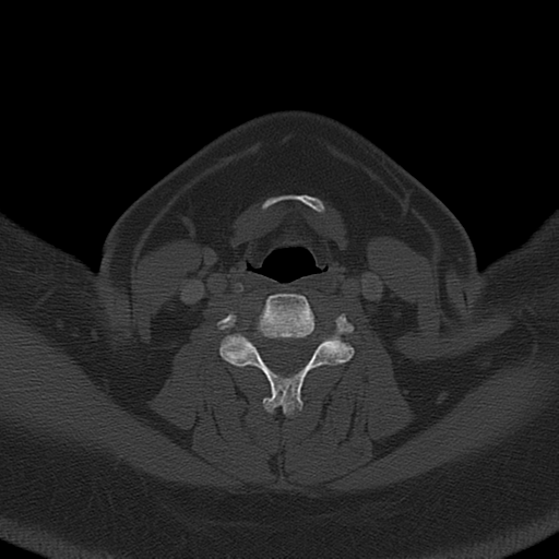 Ameloblastoma (Radiopaedia 38520-40623 Axial bone window 47).png