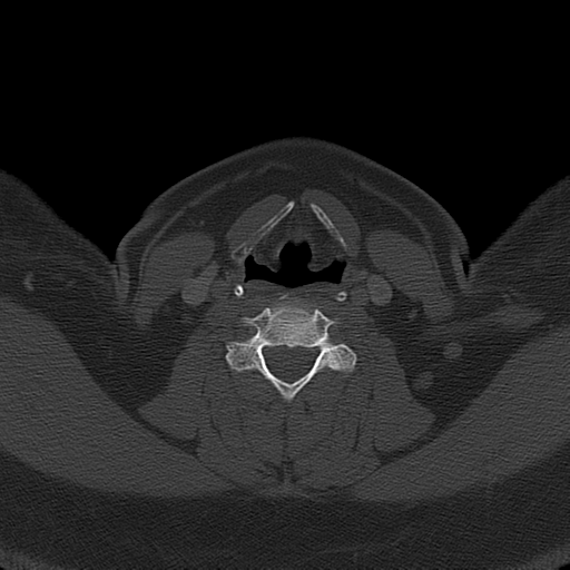 Ameloblastoma (Radiopaedia 38520-40623 Axial bone window 50).png