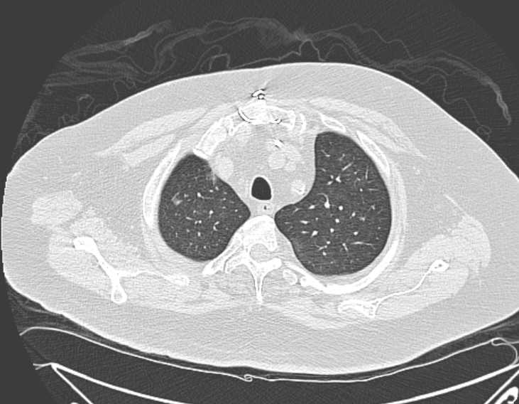 File:Amiodarone lung (Radiopaedia 62514-70769 Axial lung window 17).jpg