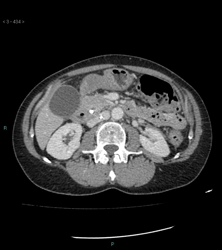 Ampulla of Vater metastasis (Radiopaedia 27820-28069 A 72).jpg