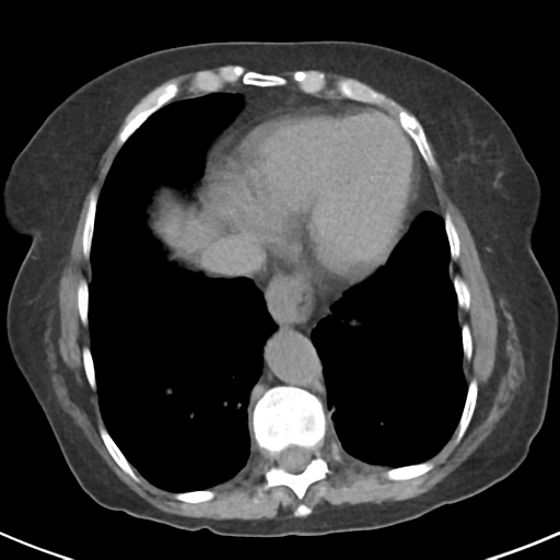 File:Ampullary adenocarcinoma (Radiopaedia 34013-35237 Axial non-contrast 4).png