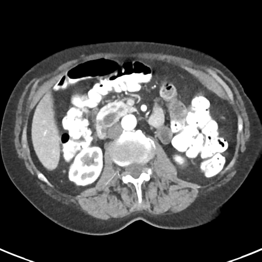 Ampullary adenocarcinoma (Radiopaedia 34013-35237 B 42).png