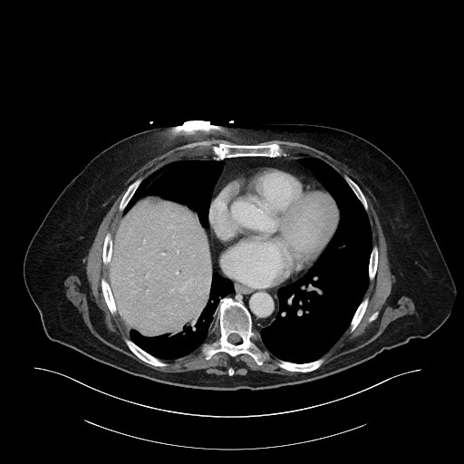 Ampullary adenocarcinoma (Radiopaedia 59373-66734 C 14).jpg