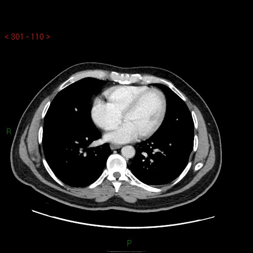 Ampullary carcinoma (Radiopaedia 56396-63056 C 1).jpg