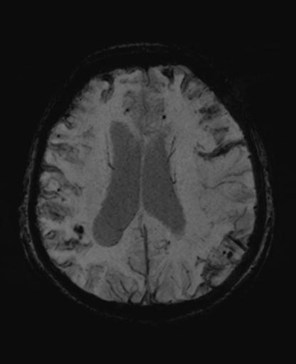 File:Amyloid angiopathy with inflammation (Radiopaedia 30360-31002 Axial SWI MIP 40).jpg