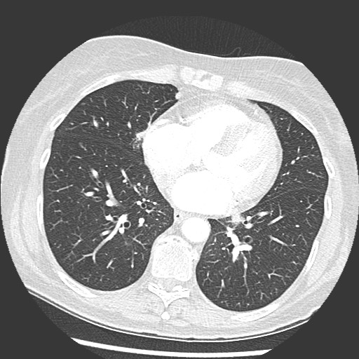 Amyloidosis - bronchial and diffuse nodular pulmonary involvement (Radiopaedia 60156-67745 Axial lung window 54).jpg