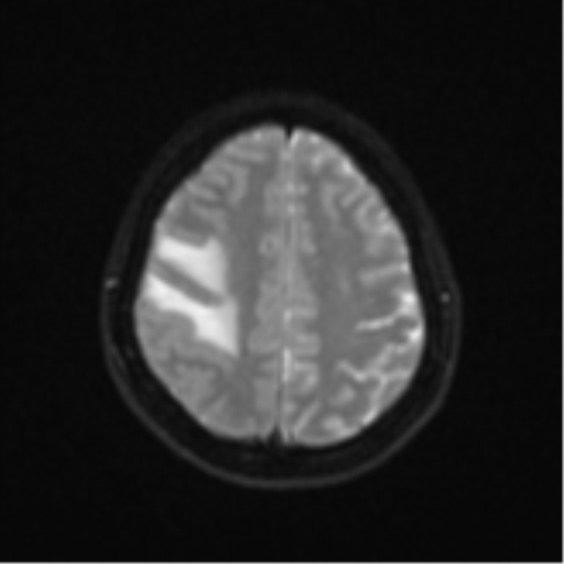 Anaplastic astroblastoma (Radiopaedia 55666-62194 Axial DWI 22).png