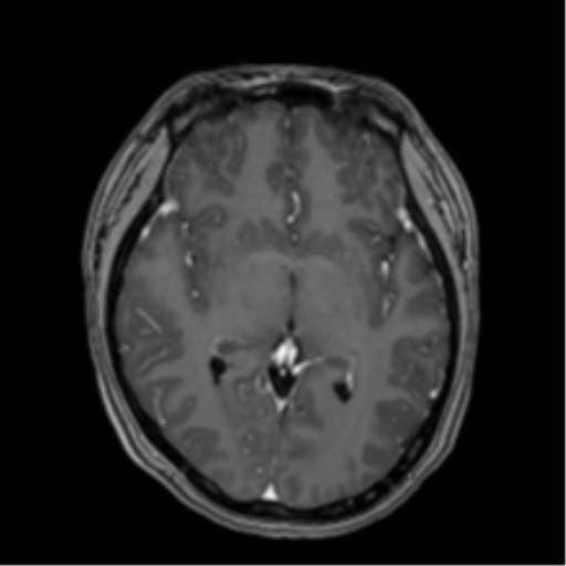 Anaplastic astroblastoma (Radiopaedia 55666-62194 Axial T1 C+ 36).png