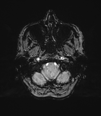 File:Anaplastic astrocytoma (Radiopaedia 86943-103160 Axial SWI 14).png