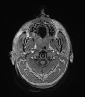 Anaplastic astrocytoma IDH wild-type (Radiopaedia 49984-55273 Axial T1 2).png