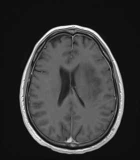 Anaplastic astrocytoma IDH wild-type (Radiopaedia 49984-55273 Axial T1 C+ 37).png